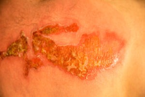 Can I Sue for Chemical Burns?