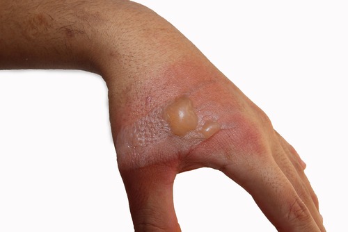 What Is the Average Settlement Value for a Burn Injury Claim?