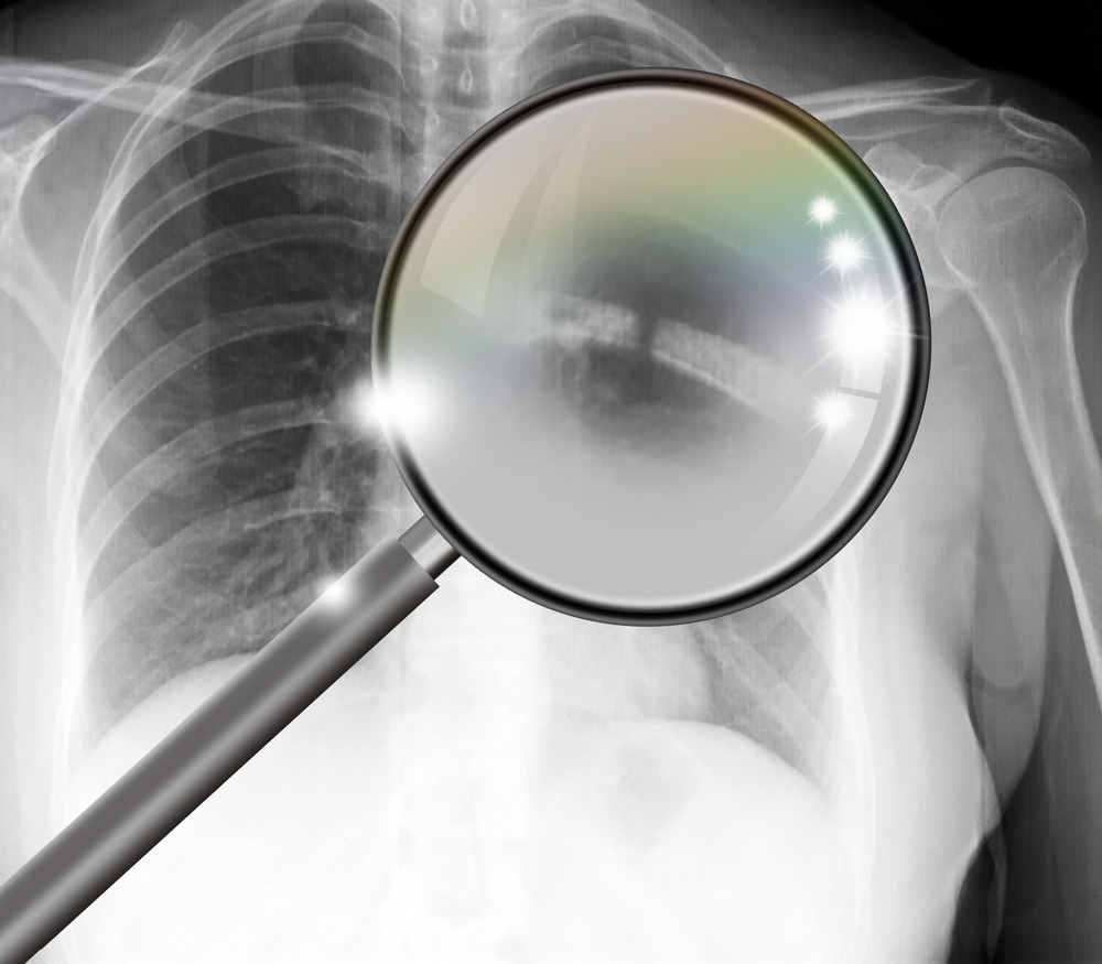 What Should I Do If I Suffered a Rib Fracture After a Motorcycle Accident?