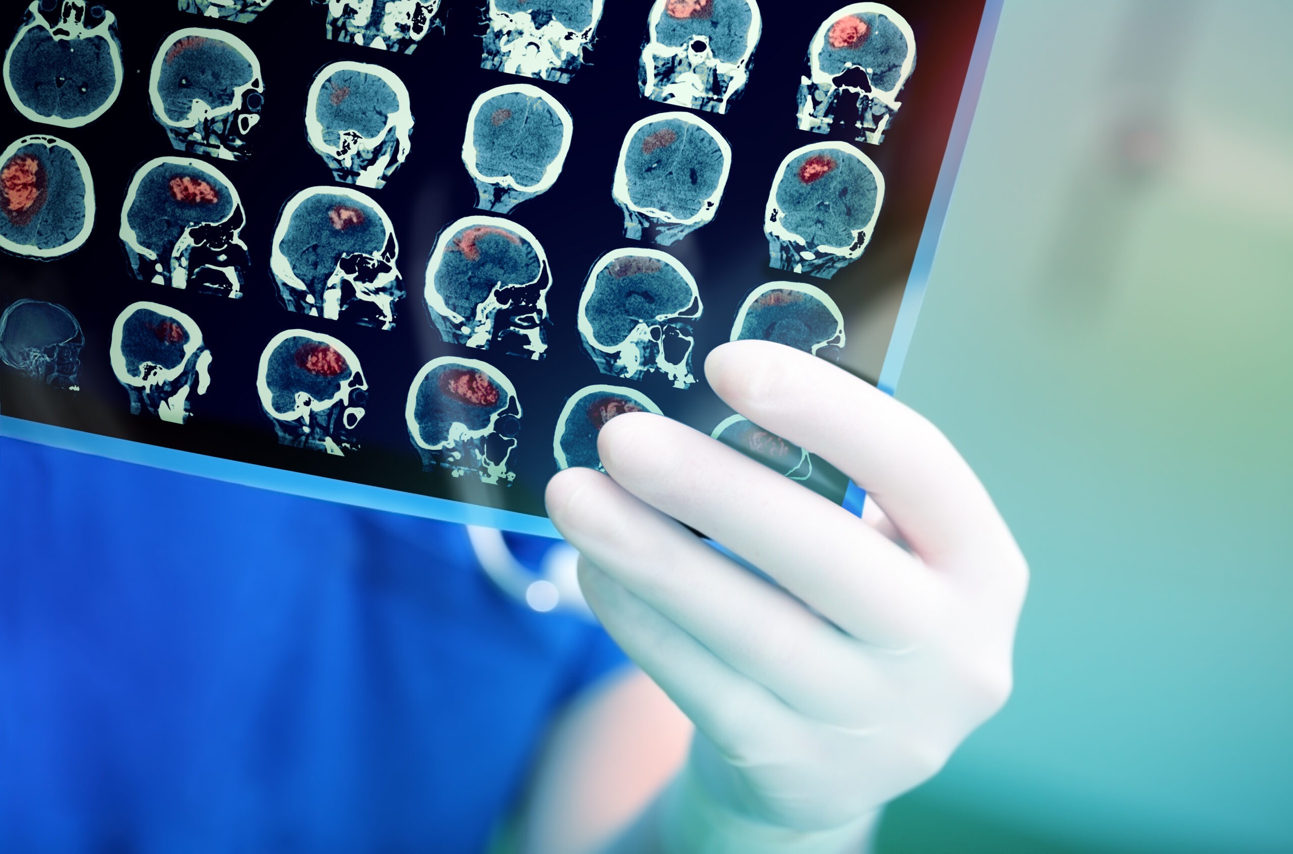Can Car Accidents Cause Brain Bleed?